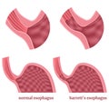 Barrett\'s esophagus. Diagram of stomach with disease.
